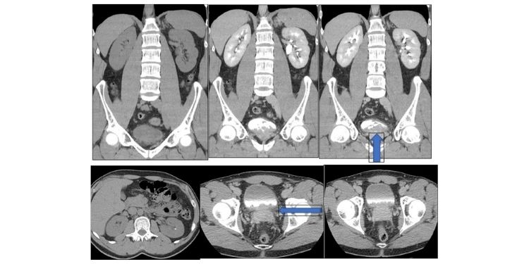 Journal of Digestive Disorders And Diagnosis-glandular cystitis