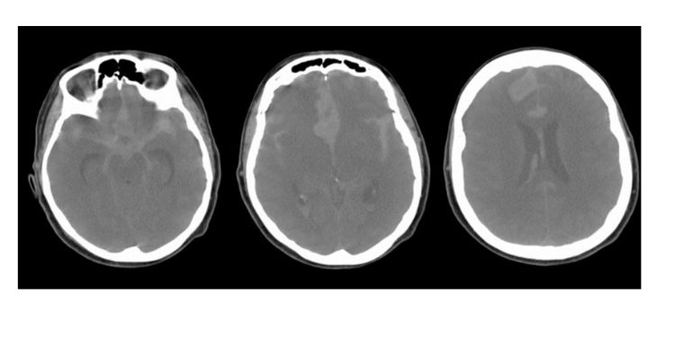 Journal of Brain And Spinal Cancer-Glioblastoma