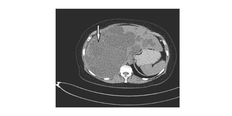 Journal of Nephrology Advances-Liver cysts