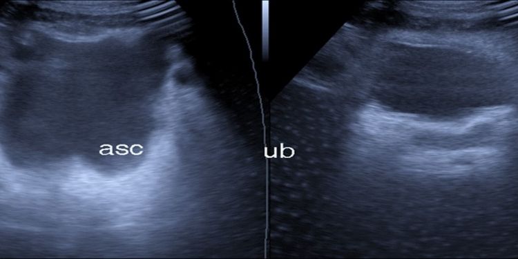 Journal of Etiological Diagnosis-Covid-19. pulmonary thromboembolism