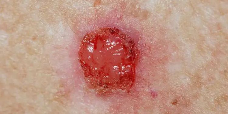 skin basal cell carcinoma