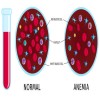 Journal of Clinical Case Reports and Images - Giant Hydrocele