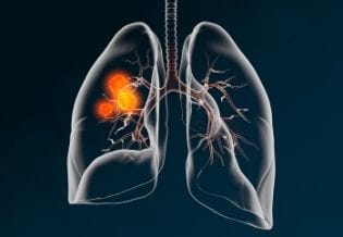 Lung Cancer