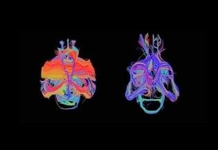 Neuroimaging